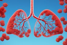 Asthma Management