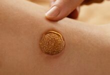 Warzen weg in 3 Tagen: Effektive Methoden zur schnellen Entfernung