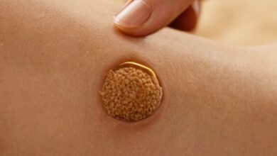 Warzen weg in 3 Tagen: Effektive Methoden zur schnellen Entfernung