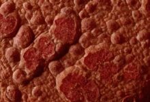 Darmpilz Symptome auf der Haut: Erkennen und Behandeln von Hautveränderungen durch Pilzinfektionen