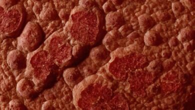 Darmpilz Symptome auf der Haut: Erkennen und Behandeln von Hautveränderungen durch Pilzinfektionen